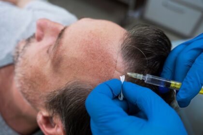 Hair Transplant